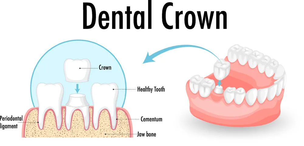 Infographic of human in dental crown